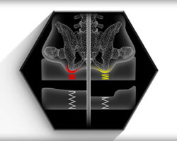 Pre Contoured Shape Axiom AS - ASP Ki Mobility Cushion